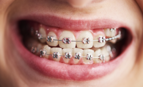 Lingual braces